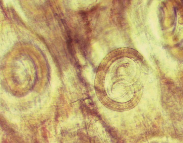 Larver av Trichinella spiralis som muskelcystor i muskelvävnad